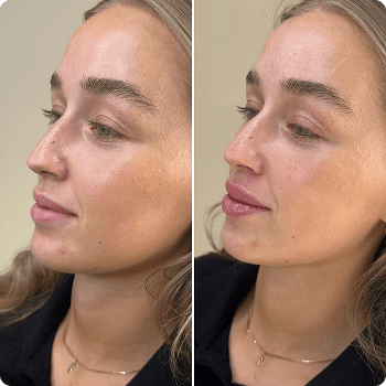 Før og efter filler, Clinic Forma Glostrup
