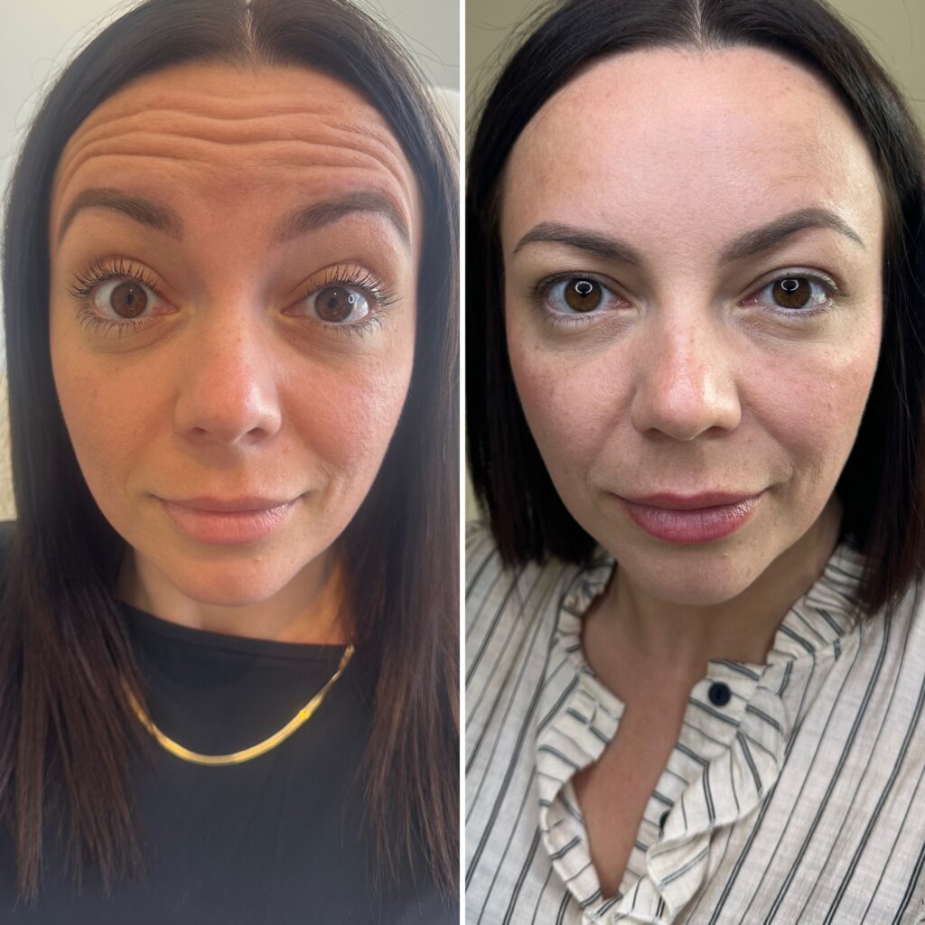 Botox nær københavn