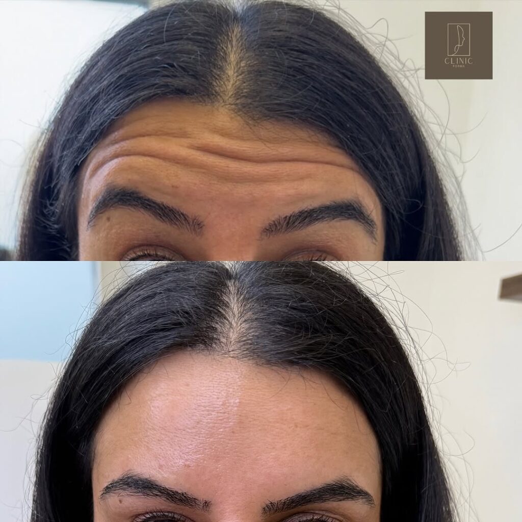 Botox behandling i Glostrup