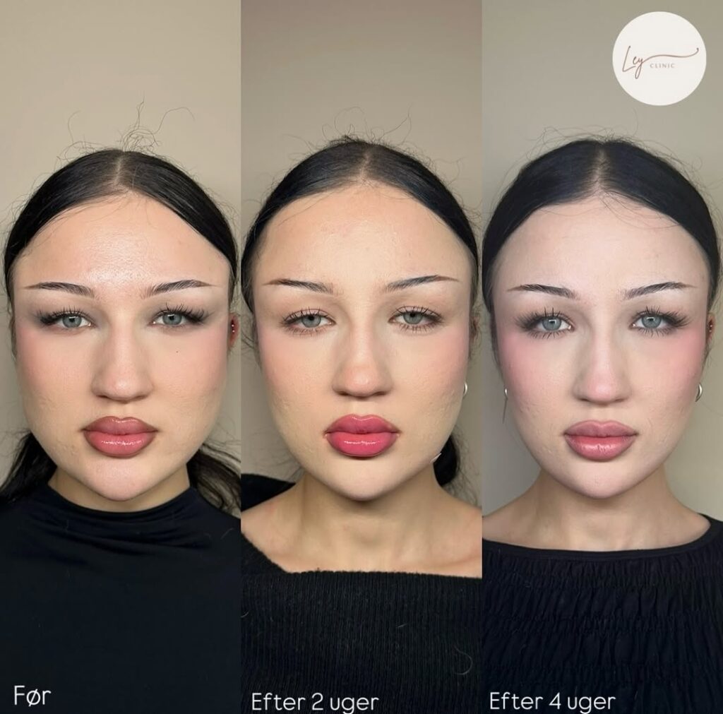 Botox masseter - Før og efter