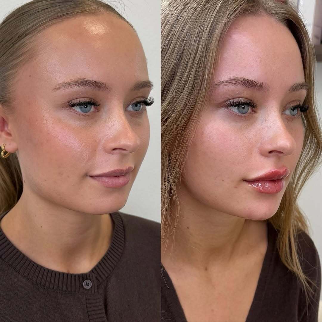 Filler-behandling hos Clinic Forma i Glostrup