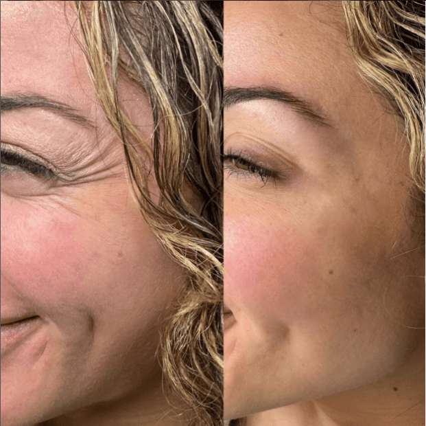 Botox-behandling af kragefødder omkring øjnene, Clinic Forma