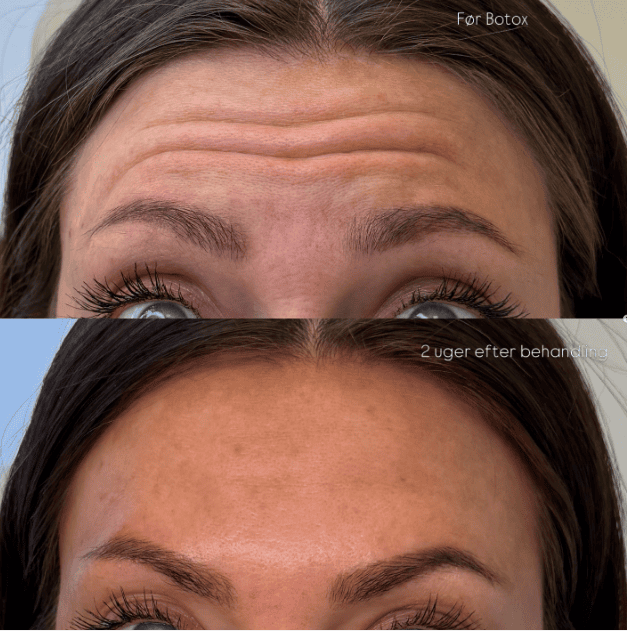 Før og efter botox-behandling af øvre ansigt, Clinic Forma