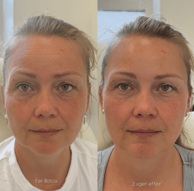 Botox-behandling hos Clinic Forma i Glostrup
