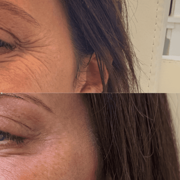 Botox-behandling, naturligt resultat, Clinic Forma