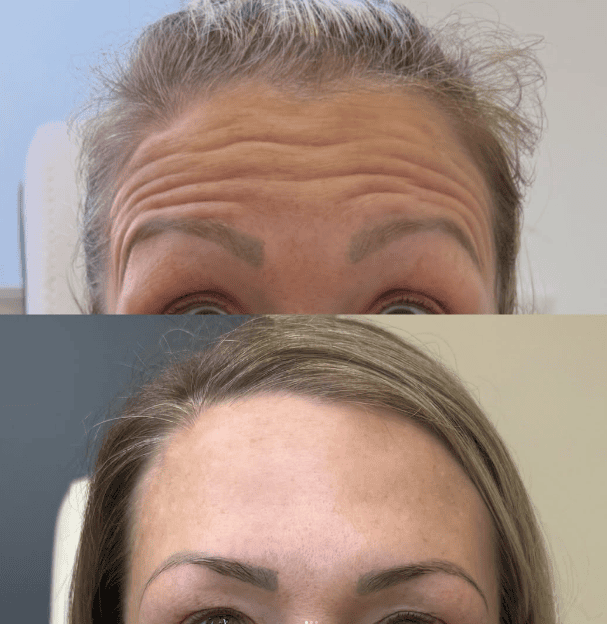 Før og efter botox mod panderynker, klient hos Clinic Forma Glostrup