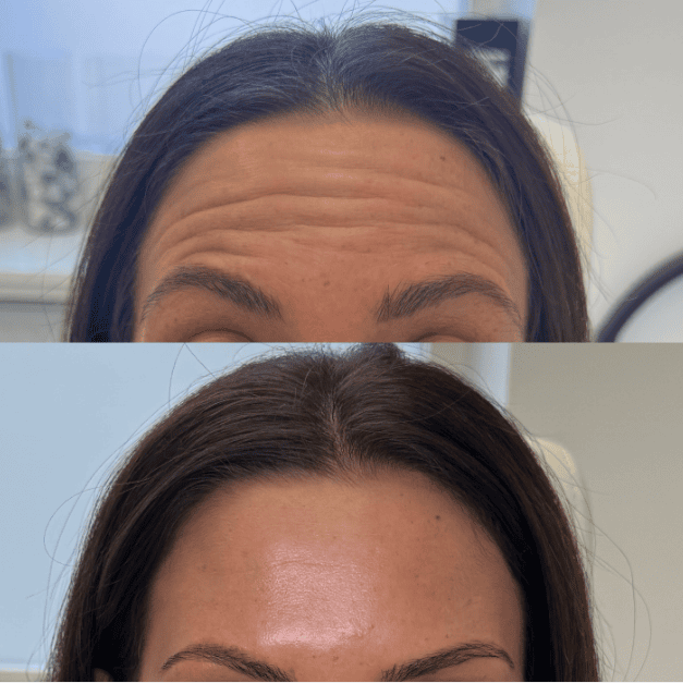 Før og efter botox, glattere pande, Clinic Forma