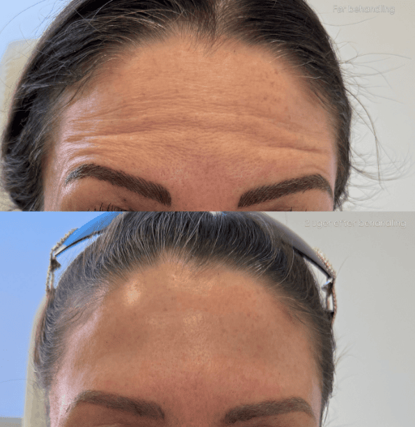 Før og efter botox mod arge-linjer, Clinic Forma Glostrup
