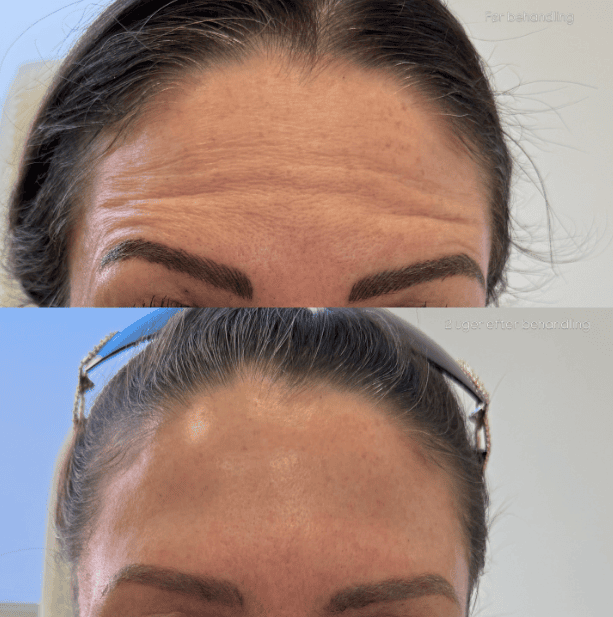Før og efter botox i panden og glabella, Clinic Forma Glostrup