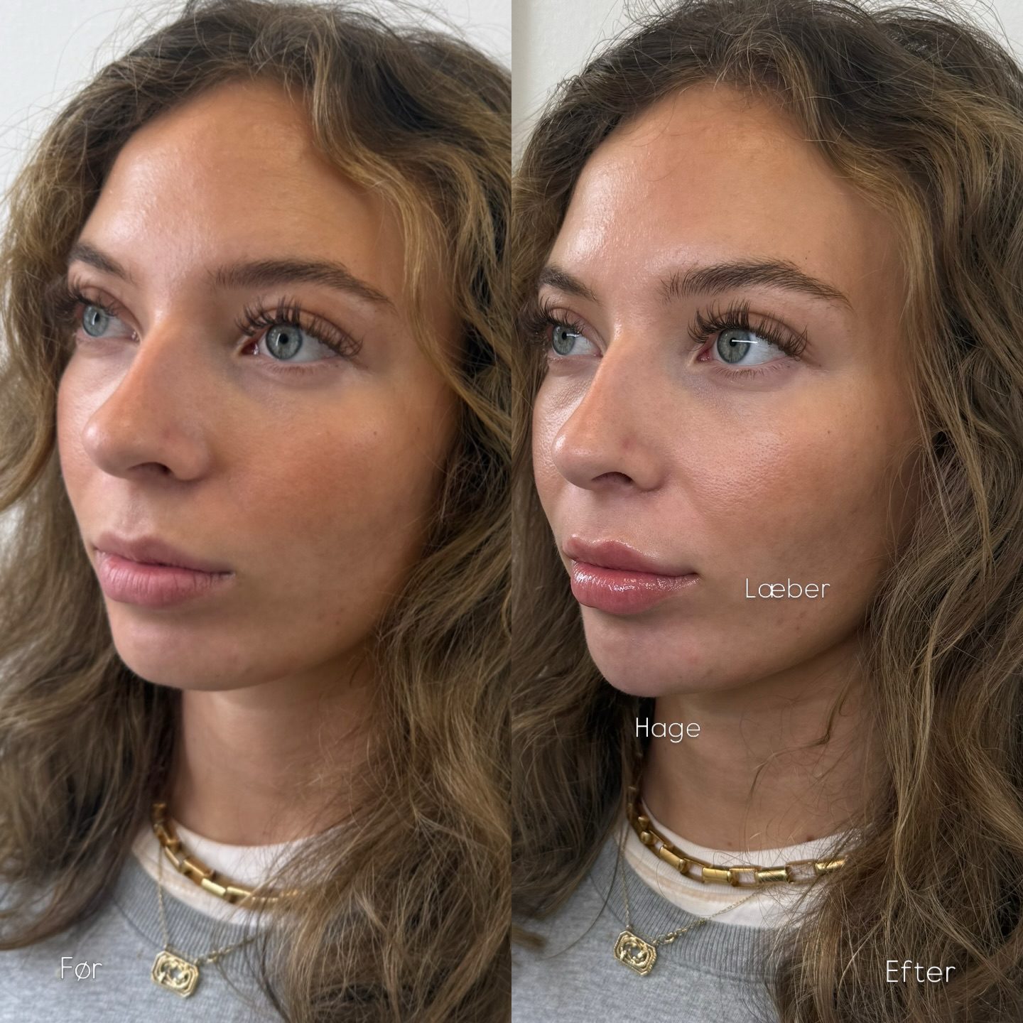 Læbe- og hagefiller-resultat, Clinic Forma