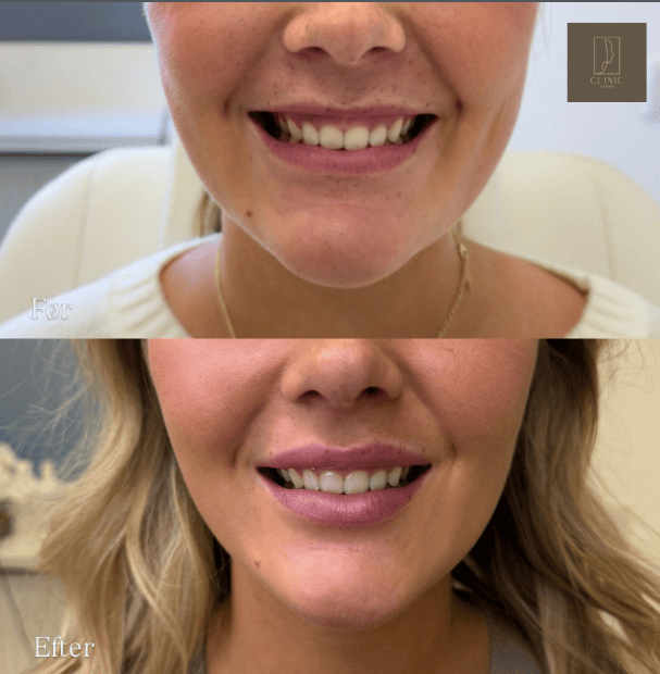 Lip flip med botox, subtilt resultat, Clinic Forma